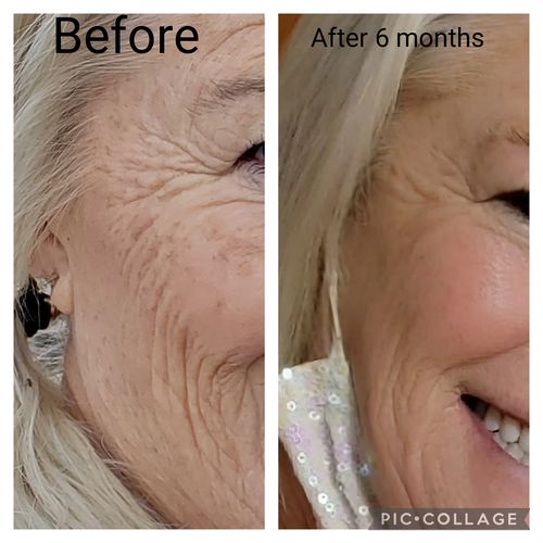 Customer photo review of EvenSkyn® Lumo: Premium Anti-Aging & Skin Tightening Handset