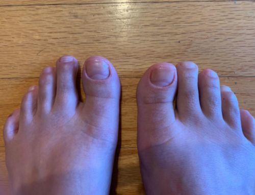 Customer photo review of German ToenailPlus™ Anti Paronychia Relief Oil