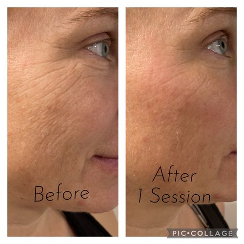 Customer photo review of EvenSkyn® Lumo: Premium Anti-Aging & Skin Tightening Handset