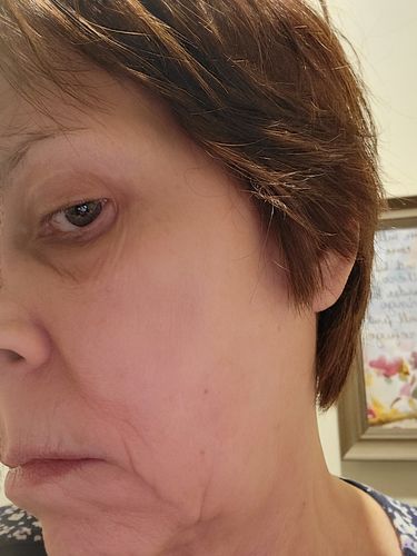 Customer photo review of EvenSkyn® Lumo: Premium Anti-Aging & Skin Tightening Handset