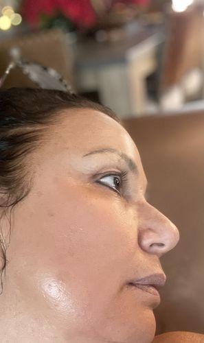 Customer photo review of EvenSkyn® Lumo: Premium Anti-Aging & Skin Tightening Handset