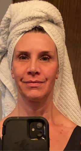 Customer photo review of EvenSkyn® Lumo: Premium Anti-Aging & Skin Tightening Handset