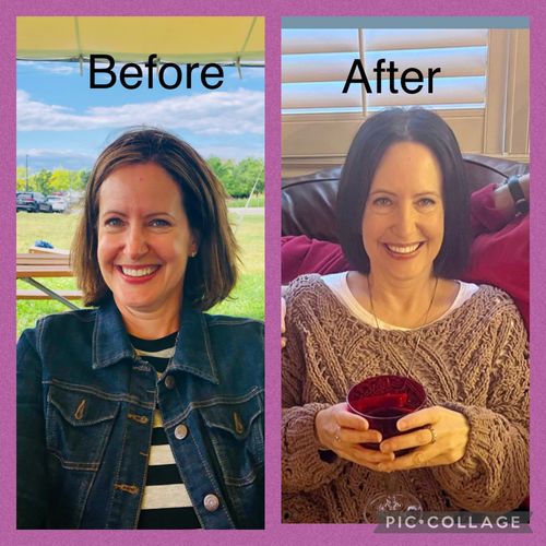 Customer photo review of EvenSkyn® Lumo: Premium Anti-Aging & Skin Tightening Handset