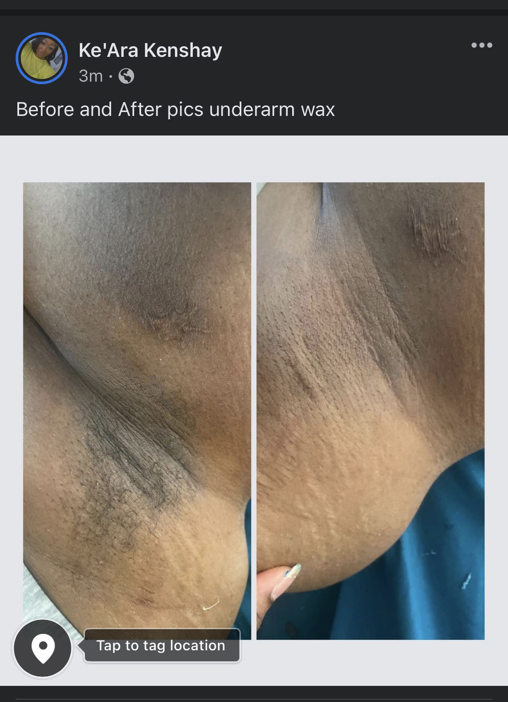 Customer photo review of Pro Series Hair Removal Wax