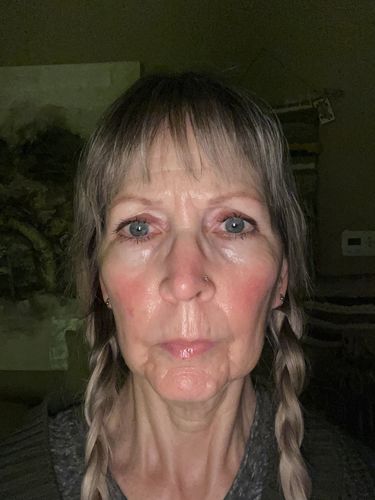 Customer photo review of EvenSkyn® Lumo: Premium Anti-Aging & Skin Tightening Handset