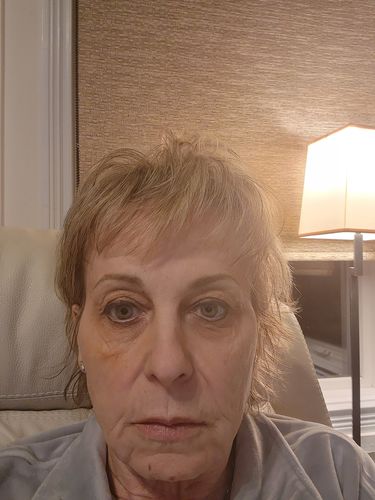 Customer photo review of EvenSkyn® Lumo: Premium Anti-Aging & Skin Tightening Handset