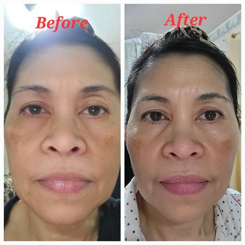 Customer photo review of EvenSkyn® Lumo: Premium Anti-Aging & Skin Tightening Handset