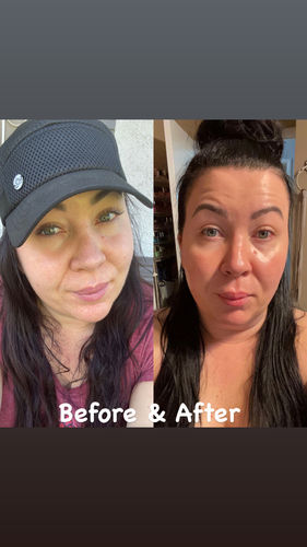 Customer photo review of EvenSkyn® Lumo: Premium Anti-Aging & Skin Tightening Handset