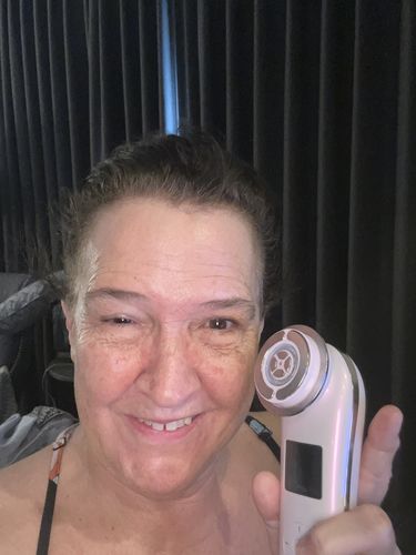 Customer photo review of EvenSkyn® Lumo: Premium Anti-Aging & Skin Tightening Handset