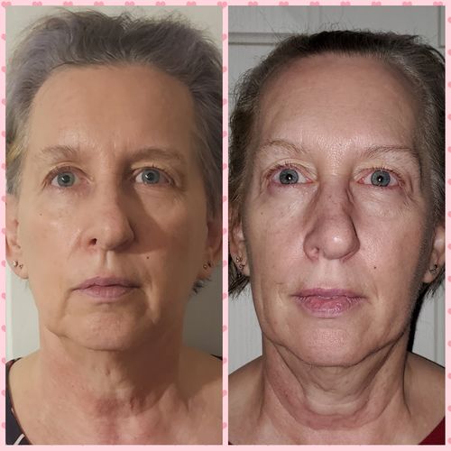 Customer photo review of EvenSkyn® Lumo: Premium Anti-Aging & Skin Tightening Handset
