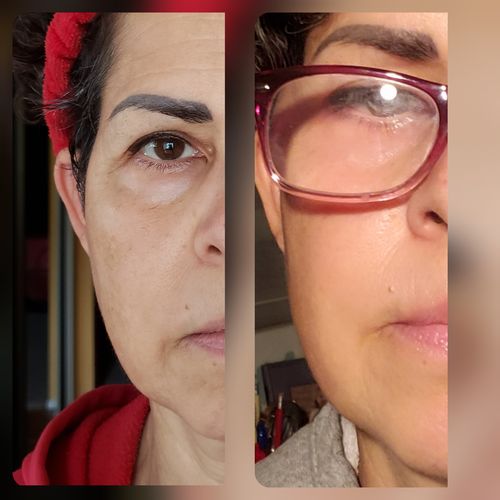 Customer photo review of EvenSkyn® Lumo: Premium Anti-Aging & Skin Tightening Handset