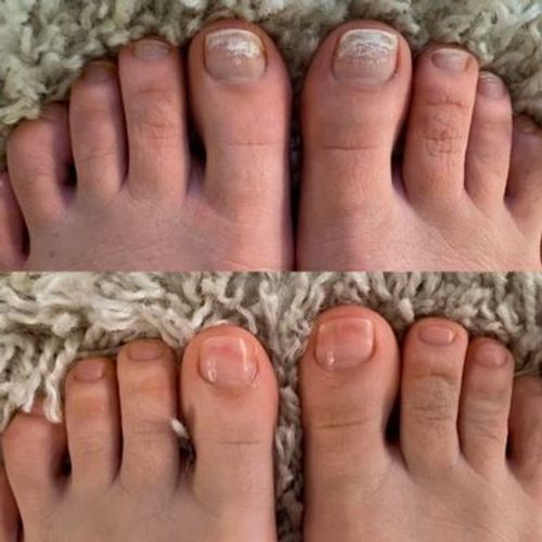 Customer photo review of NagelCare™ Anti-Svamp Eterisk Olja