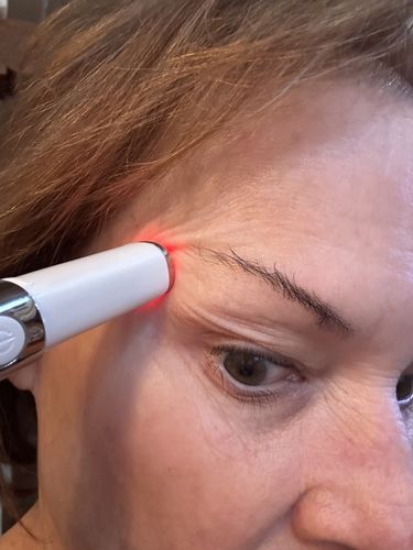Customer photo review of EvenSkyn® Lumo: Premium Anti-Aging & Skin Tightening Handset