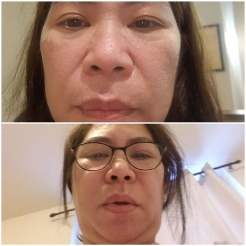 Customer photo review of EvenSkyn® Lumo: Premium Anti-Aging & Skin Tightening Handset