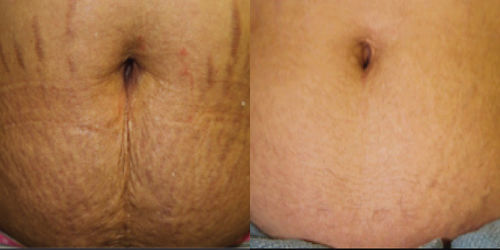 Customer photo review of StretchClear™ Graviditets Hudbristningar Borttagningskräm