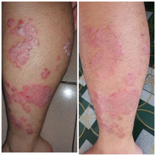 Customer photo review of Jolicare™ Treatment Set - Buy 1 Free 2 (Christmas Gift Promo)