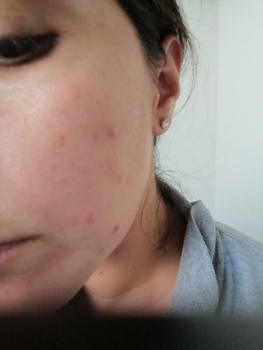 Customer photo review of Dermolimpiador acne control