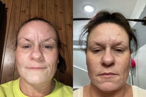 Customer photo review of EvenSkyn® Lumo: Premium Anti-Aging & Skin Tightening Handset