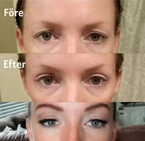 Customer photo review of MagiskaEyelids™ 240-Stycken Dubbla Ögonlocksnätklistermärken