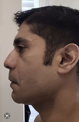 Customer photo review of EvenSkyn® Lumo: Premium Anti-Aging & Skin Tightening Handset