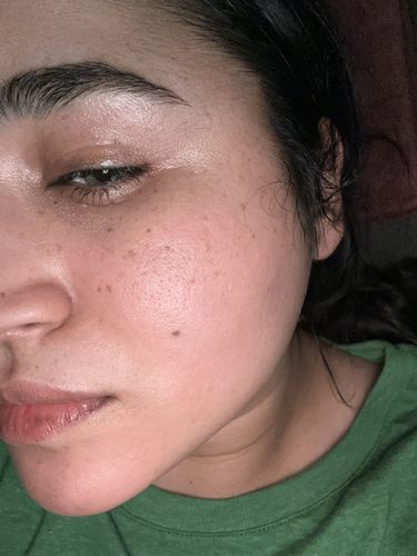 Customer photo review of EvenSkyn® Lumo: Premium Anti-Aging & Skin Tightening Handset