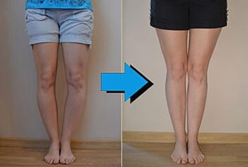 Customer photo review of LegCorrector™
