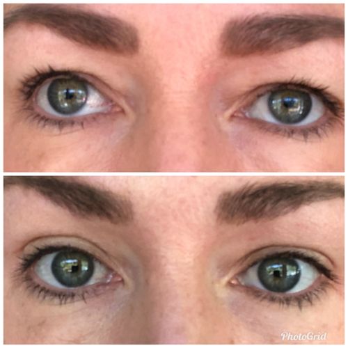 Customer photo review of MagiskaEyelids™ 240-Stycken Dubbla Ögonlocksnätklistermärken