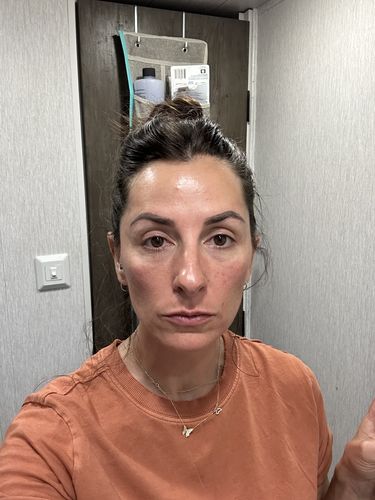 Customer photo review of EvenSkyn® Lumo: Premium Anti-Aging & Skin Tightening Handset