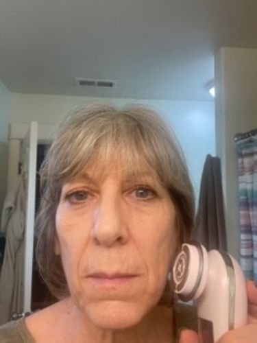 Customer photo review of EvenSkyn® Lumo: Premium Anti-Aging & Skin Tightening Handset