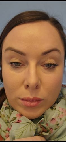 Customer photo review of EvenSkyn® Lumo: Premium Anti-Aging & Skin Tightening Handset