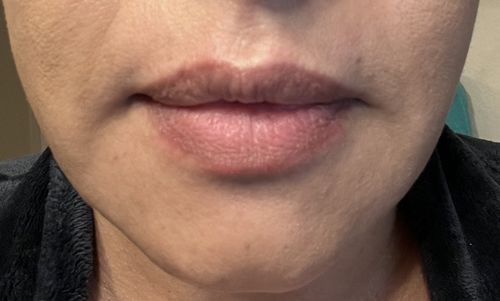 Customer photo review of EvenSkyn® Lumo: Premium Anti-Aging & Skin Tightening Handset
