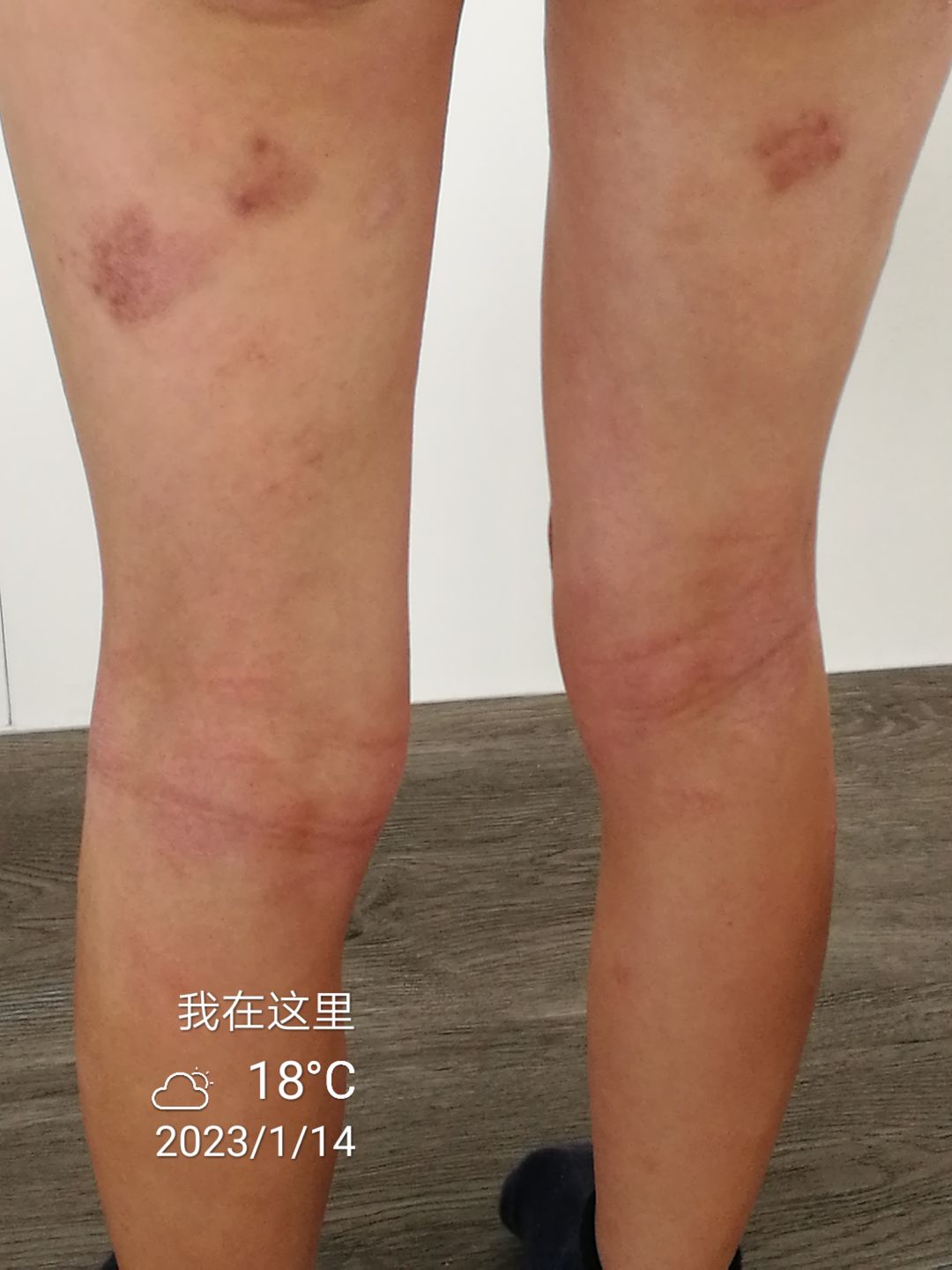 Customer photo review of Eczema Saviour