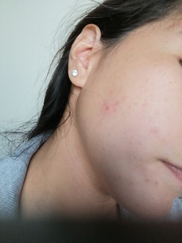 Customer photo review of Dermolimpiador oil control