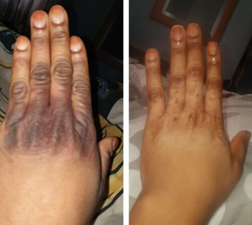 Customer photo review of InstaVit™ Knog Blekning Serum