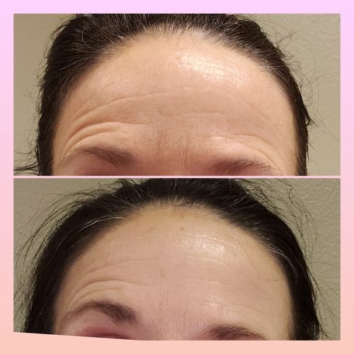 Customer photo review of EvenSkyn® Lumo: Premium Anti-Aging & Skin Tightening Handset