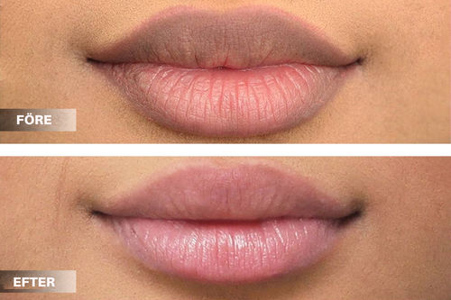 Customer photo review of LäppPlumper™ Blekande Läppbalsam