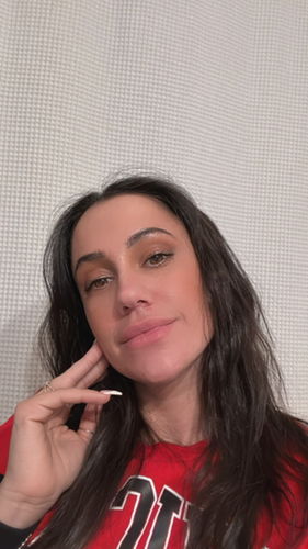Customer photo review of WrinkleFix: Botox Membership