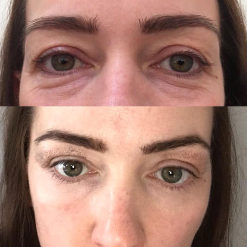 Customer photo review of EyebagsRemover™