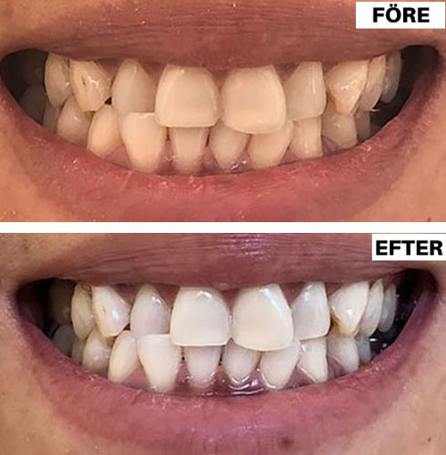 Customer photo review of PerfektLeende™ Intensiv Anti-Fläckblekande Tandkräm