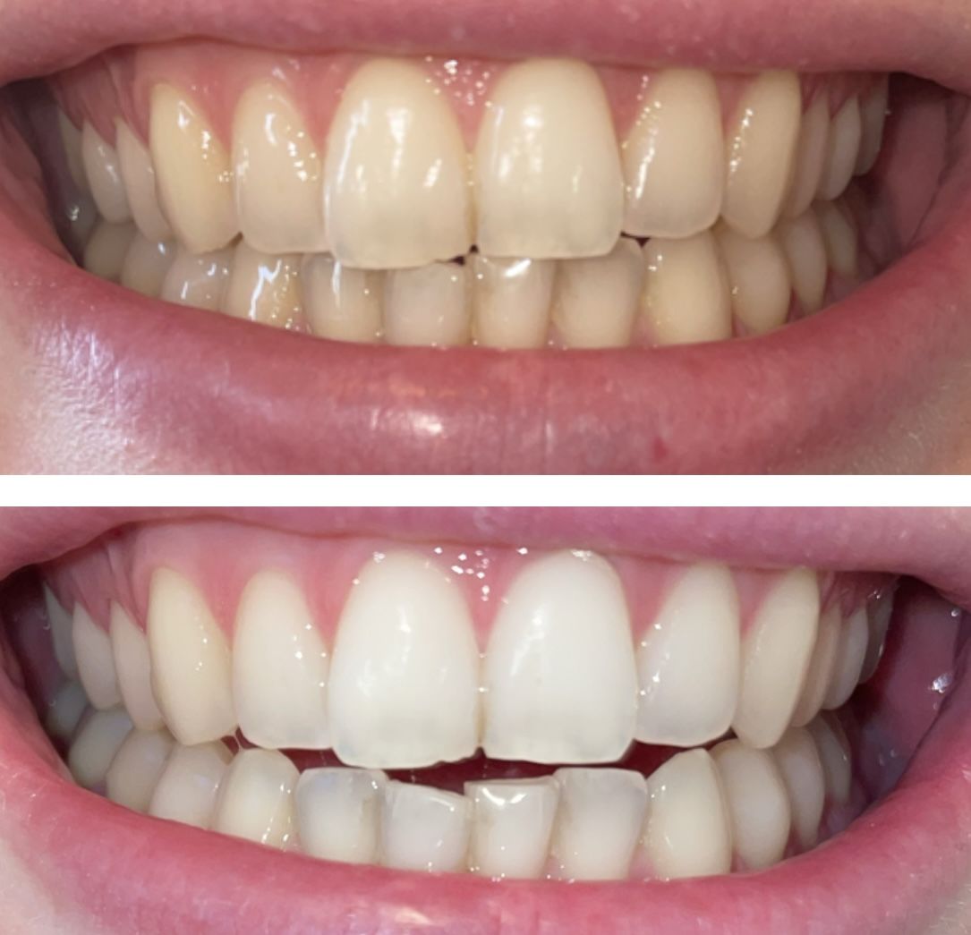 Customer photo review of Teeth Whitening Kit