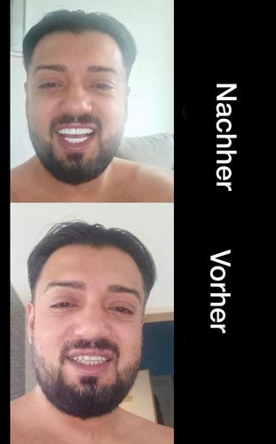 Customer photo review of Teeth-Veneer 2.0