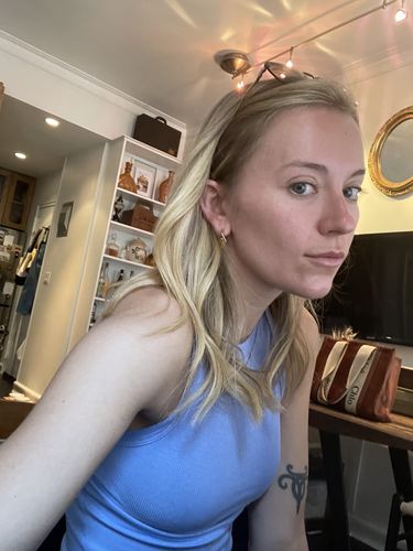 Customer photo review of WrinkleFix: Botox (Existing Customers)
