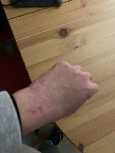 Customer photo review of Coco 清爽保濕套裝 (濕疹修護霜+蘆薈舒緩保濕凝膠)