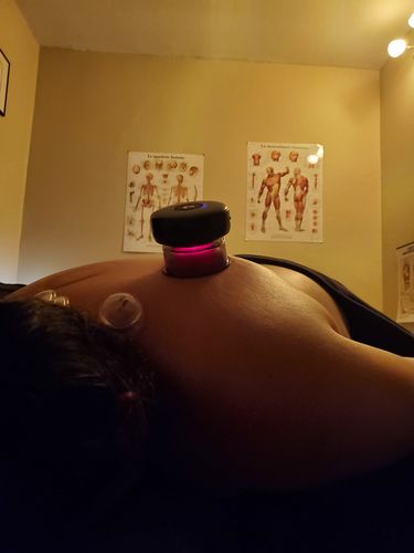 Customer photo review of Achedaway Cupper - The Smart Cupping Therapy Massager