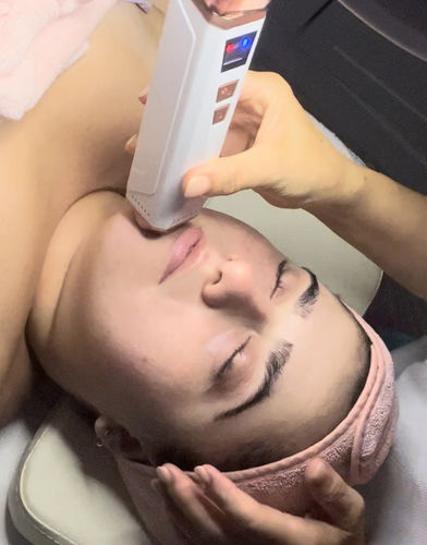 Customer photo review of Femvy Blackhead Remover 2.0