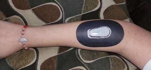 Customer photo review of Skin Grip MAX Dexcom G6 Patches