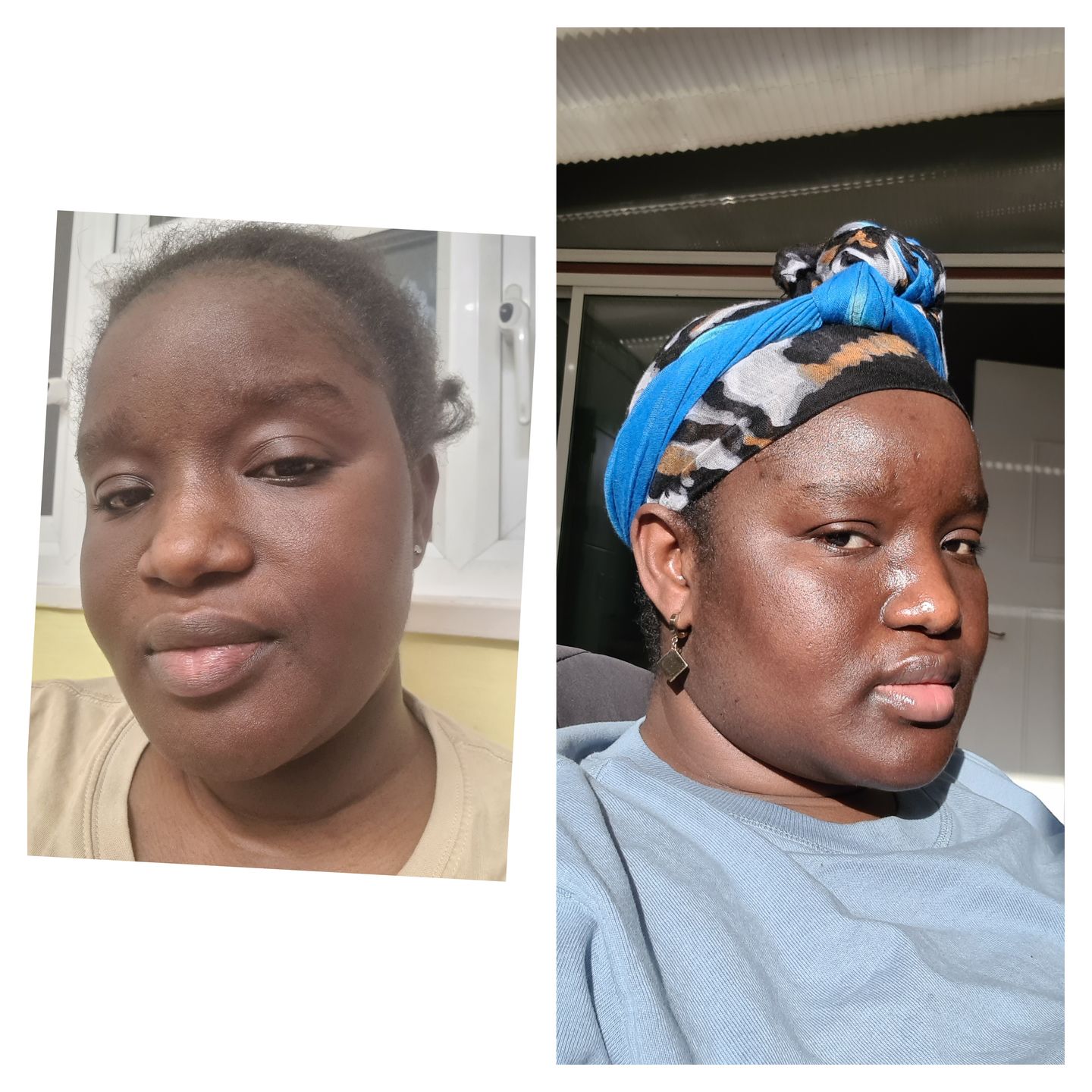 Customer photo review of NEW Redness and Burn Face Cream