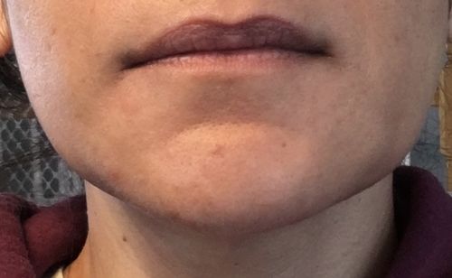 Customer photo review of EvenSkyn® Lumo: Premium Anti-Aging & Skin Tightening Handset