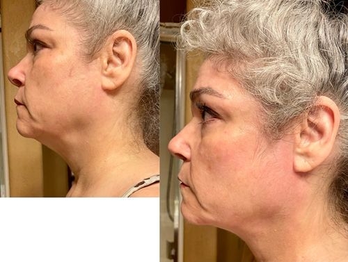 Customer photo review of EvenSkyn® Lumo: Premium Anti-Aging & Skin Tightening Handset