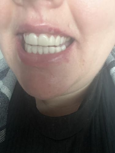 Customer photo review of Teeth-Veneer 2.0